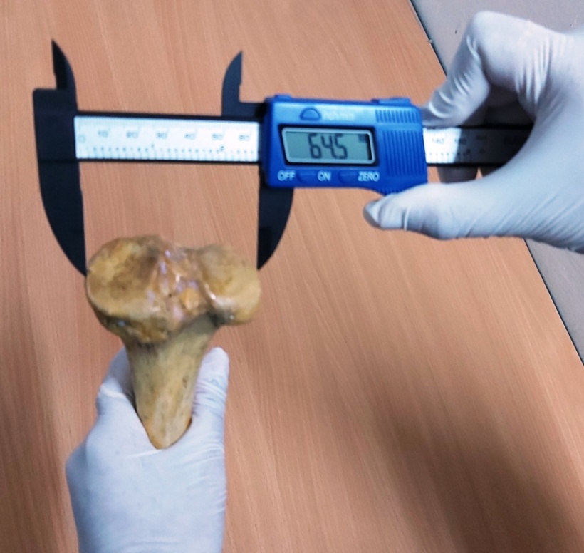 Measurement of total tibial condyle T-D diameter