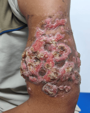 Erythematous indurated plaque with nodules and crusts over left arm in botryomycosis