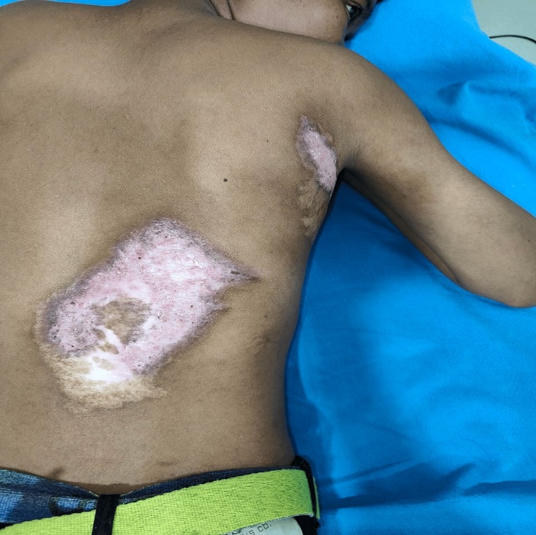 Treatment response after 2 months of starting Antitubercular therapy