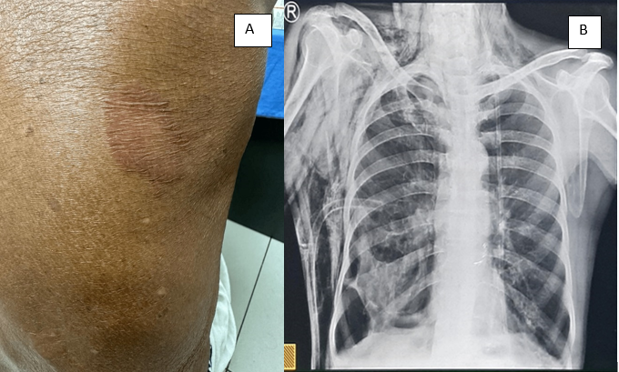 A: Erythematous oedematous annular plaque over right side of posterior trunk and B: Chest X ray showing Bilateral hyperinflated lungs with right lower zone emphysematous bullae with right ICD in situ