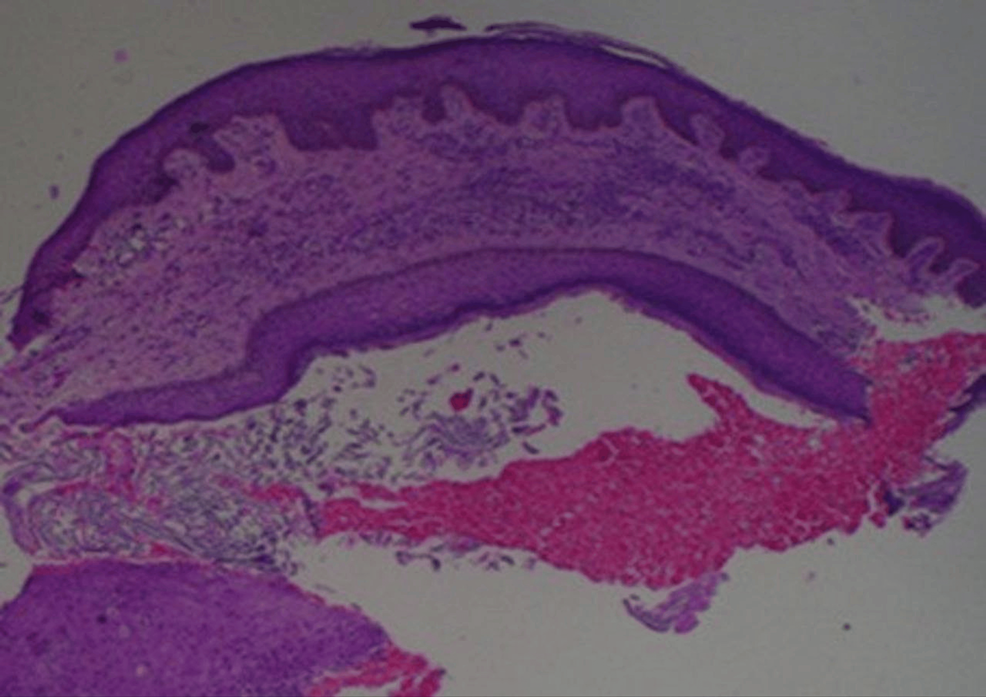 Histopathology of furunculosis showing infective granuloma