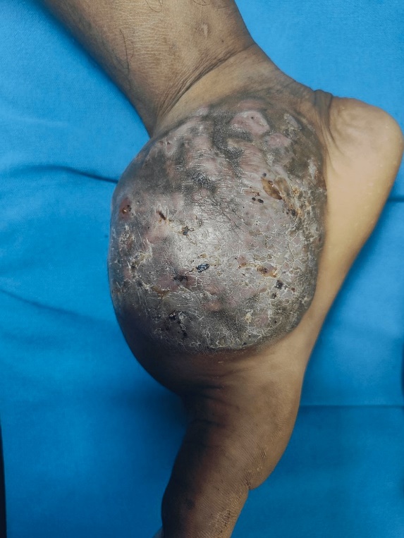 Painless subcutaneous swelling with discharging sinuses over right dorsum of foot.