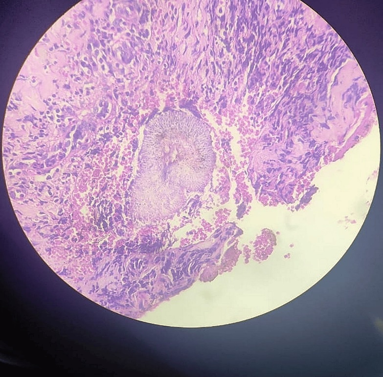 Histopathological image of eumycotic mycetoma