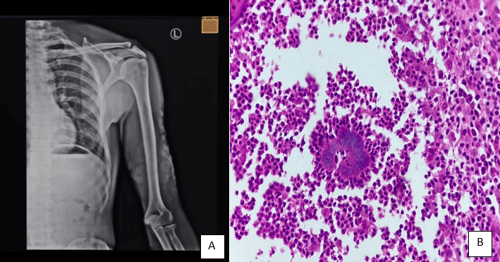 A: X-Ray left Elbow AP & Lateral view shows no underlying bone involvement and B: Biopsy showing Bollinger granules showing “Splendore -Hoeppli” phenomenon