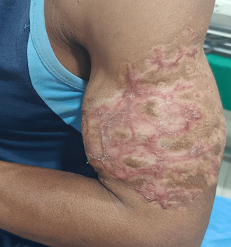 After 3 months of treatment