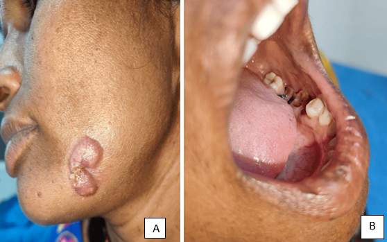 A: Erythematous indurated plaque with discharging sinus over skin overlying left mandible and B: showing route of infection with dental caries