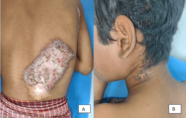 A: Shows Erythematous crusted plaque with atrophic scarring at one end over posterior aspect of lower trunk and B: Showing Erythematous plaque with discharging sinus present over left side of nape of neck.