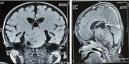 MRI brain at 14mo, showing a fairly well defined extra axial lesion in the suprasellar cistern with mild interval increase in its size 4.97 X 4.9 X 3.5 cm - Suggestive of pedunculated large hypothalamic hamartoma.