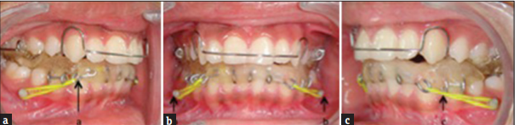 Modified twin block with mini-implants