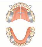 Twin block with spinner andocclusal rest