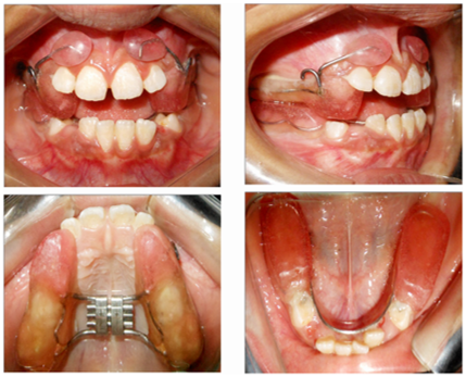 Modified twin block for class III with lip pads
