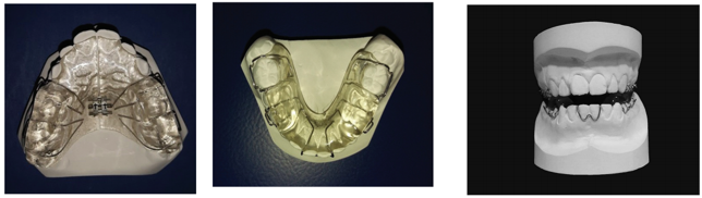 Modified twin block with Southend clasp on lower central incisors