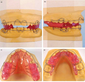 Modified twin block with Southend clasp on upper and lower central incisors