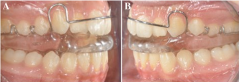 Modified twin block with acrylic capping