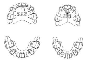 Modified twin block for class II Div.2