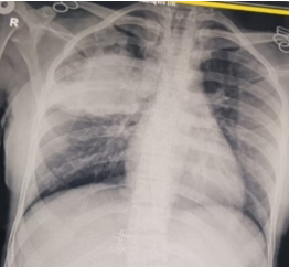 X-ray chest PA view of the patient at the time of presentation