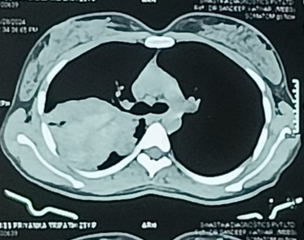 CT thorax suggestive of mass like lesion