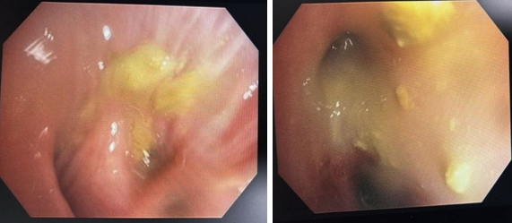 Bronchoscopic finding