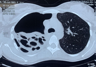 Computed Tomography of the chest after pneumothorax and ICD insertion