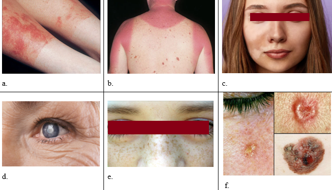 Pictures of sun damaging effects a: picture of photoallergic reaction (12). b: picture of acute sunburn c: picture of skin pigmentation (14). d: picture of wrinkles (15). e: picture of freckles (16). f: picture of skin cancer.12