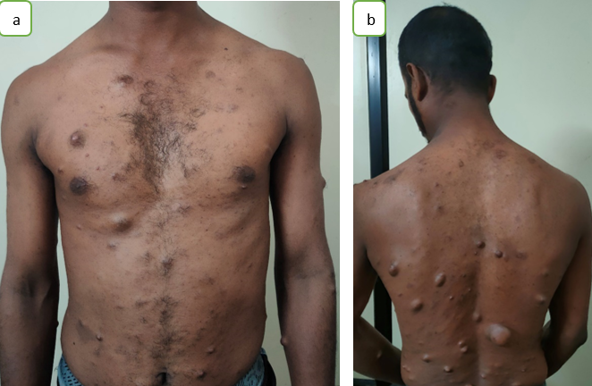 a,b: cutaneous neurofibromas