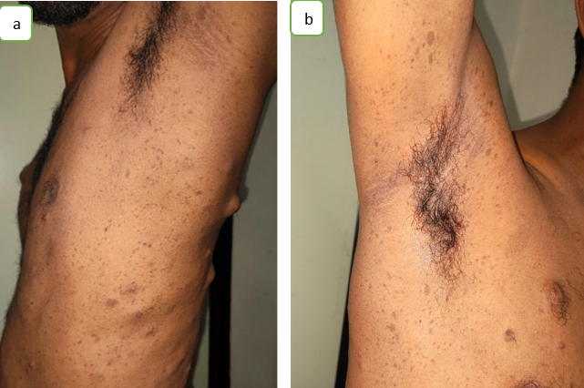 a,b: Café au lait pigmentation