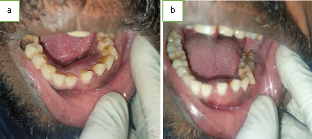 a,b: A diffuse enlargement of gingiva, involving the attached, marginal gingiva and interdental papilla in the buccal and lingual aspect of mandibular teeth, extending from 43 to 38 region.