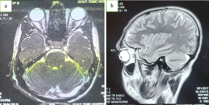 a: Showing thickened left optic nerve which is fusiform in shape and likely to be optic glioma; b: showing a hyperintense extracalvarial lesion noted in the right frontotemporoparietal concavity suggestive of plexiform neurofibroma