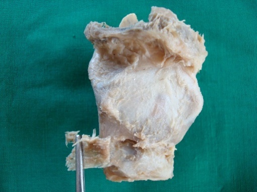 Showing removal of cricothyroid muscle
