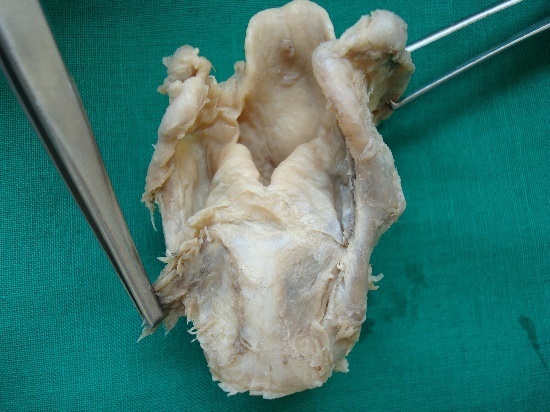 Showing removal of posterior cricoarytenoid muscle