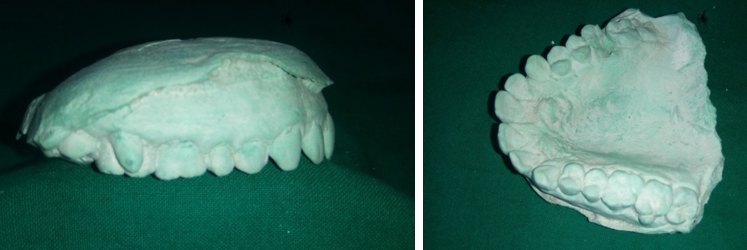 Showing parastyle on dental cast (buccal & occlusal view)