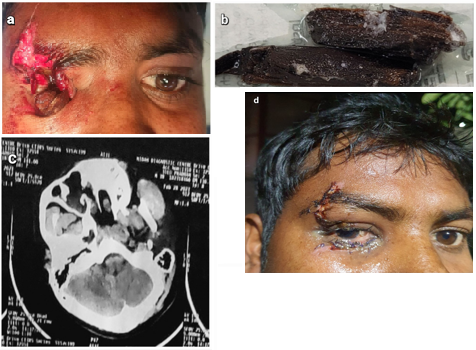 a: Pre op photograph of patient showing extensive laceration with intraocular foreign body; b: Giant wooden foreign body of size 6cm x 4cm; c: CT scan of patent showing the wooden foreign body; d: Post op of photograph of patient at day 10.