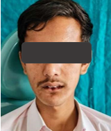 Extra oral view of mandibulectomy patients