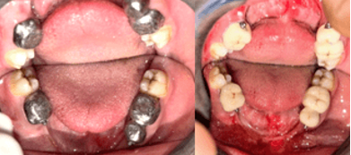 Metal coping with patrix attachment try in & after metal try-in, PFM crowns were cemented