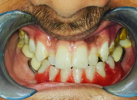 Try in denture