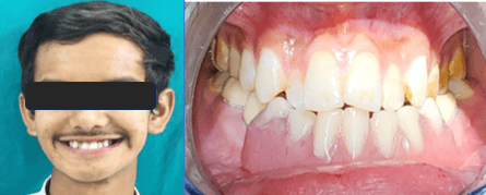 Post treatment
