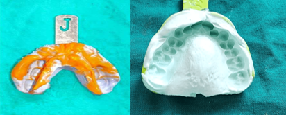 Mandibular impression made with polyvinyl siloxane material & Maxillary arch impression made with irreversible hydrocolloid impression material.
