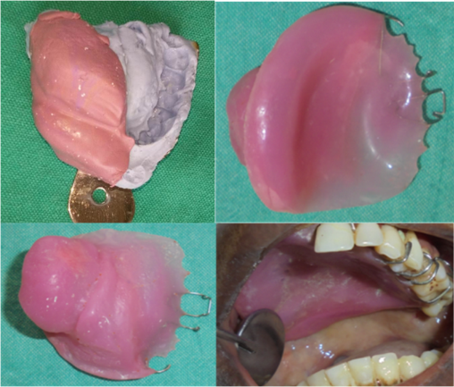 Stage I Fabrication of palatal and bulb portion of theobturator