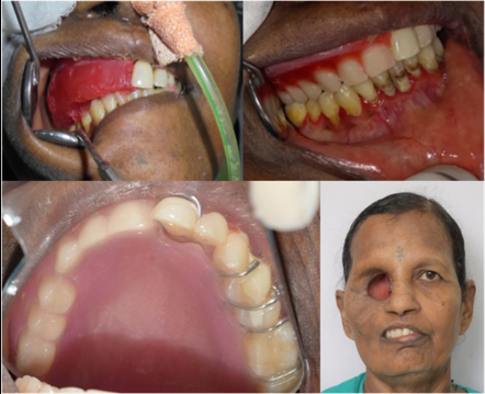 Stage II Establishment of occlusion
