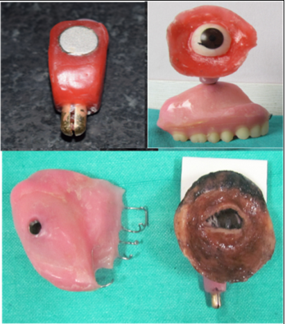 Stage III Customization of the retentive attachment