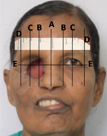 Iris placement using facial measurements