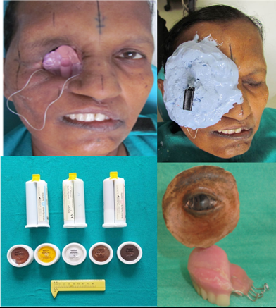Stage IV Fabrication of theextraoral prosthesis