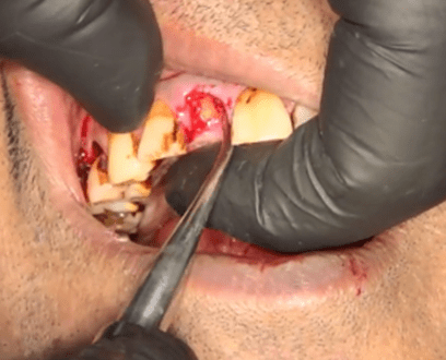 Extraction of tooth