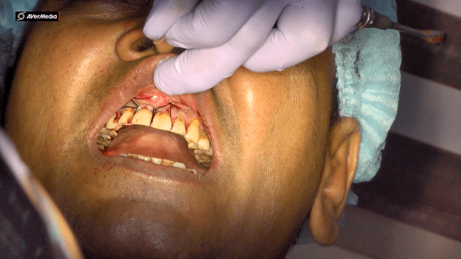 Sutures were placed