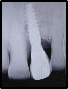X-ray showing graft and membrane placement 