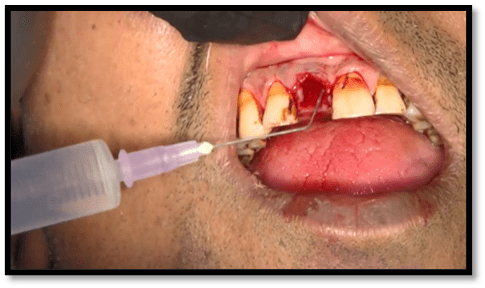 Irrigation with normal saline