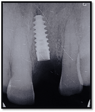 X-ray showing implant placement