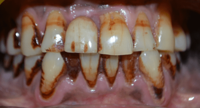 occlusion was checked