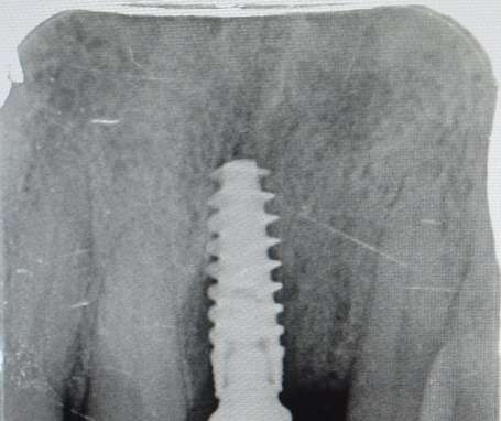 X -ray showing bone loss around implant