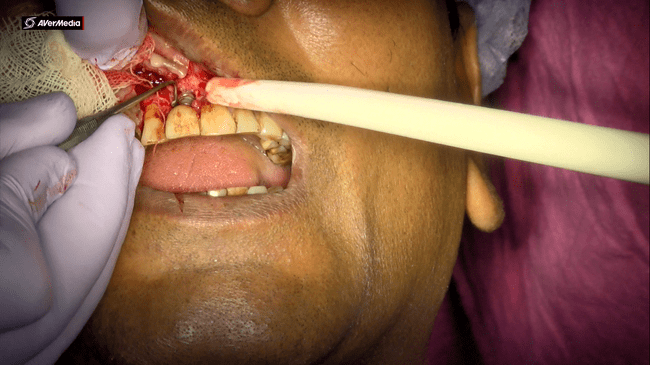 Curettage around implant